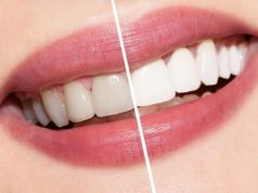 Profesjonalne wybielanie zębów przez stomatologa – WARTO?! profesjonalne-wybielanie-zebow