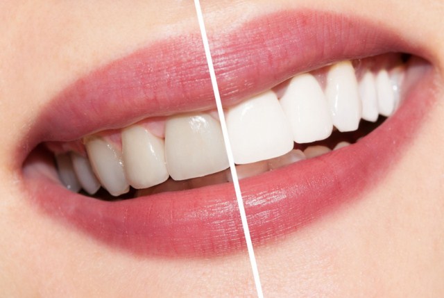 ​Профессиональное отбеливание зубов – преимущества