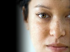 Zastosowanie kwasów w kosmetykach przebarwienia-na-twarzy