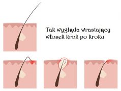 Wrastające włoski – 5 domowych sposobów! wrastajace-wloski