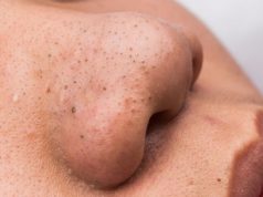 Wągry na nosie – co jest przyczyną ich pojawiania się? wągry-na-nosie