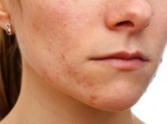 Jak usunąć wągry? OTO 4 błyskawiczne sposoby!