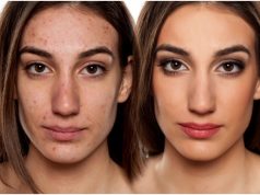 Trądzik u dorosłych – gdy problem pojawia się w późnym wieku trądzik-u-osoby-dorosłej